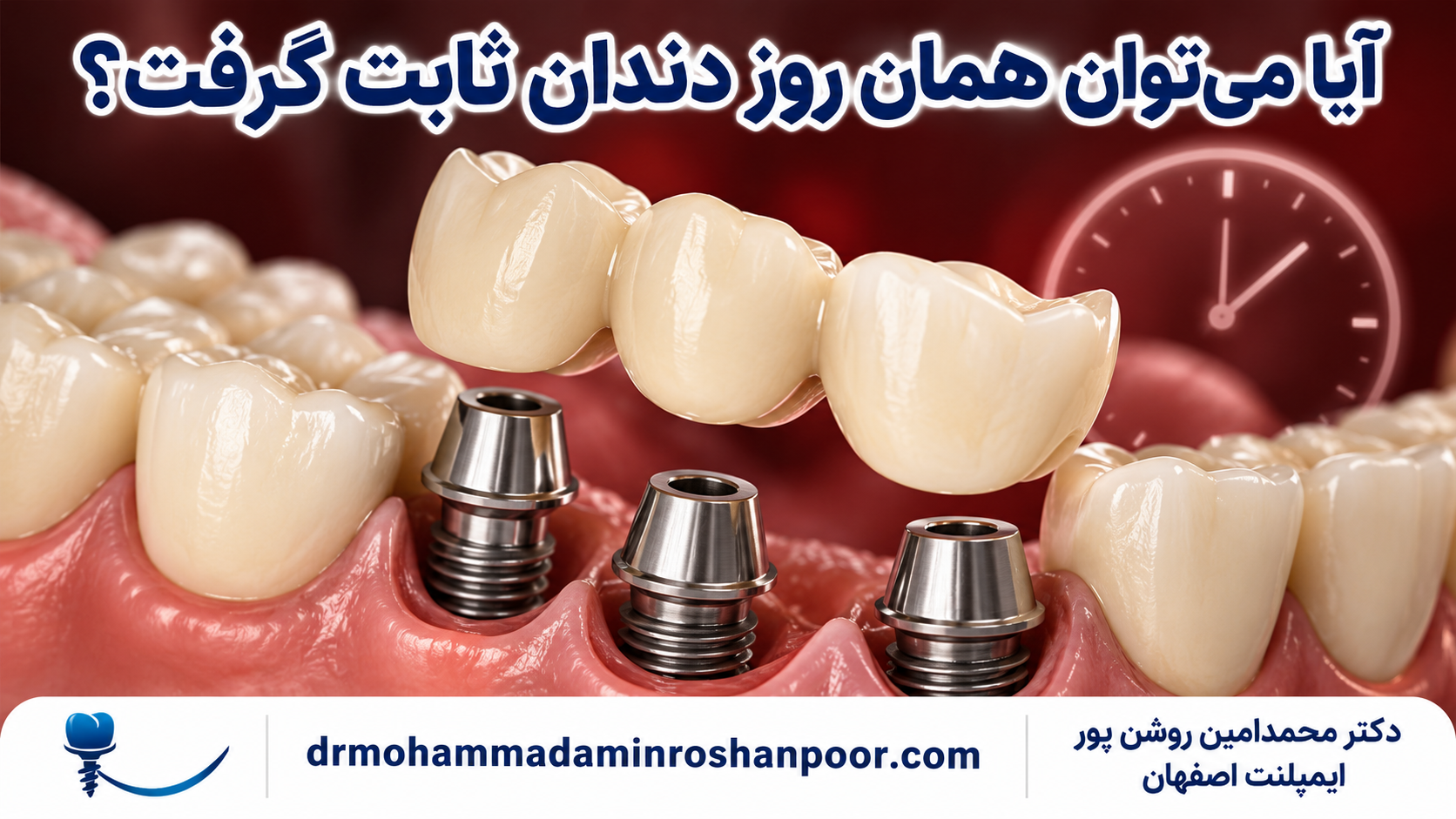 تصویرسازی آموزشی درباره امکان تحویل دندان موقت فوری روی ایمپلنت