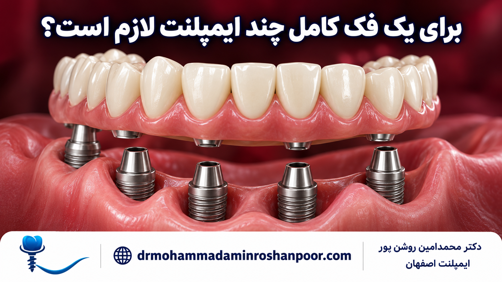 تصویرسازی آموزشی تعداد پایه‌های ایمپلنت برای بازسازی یک فک کامل
