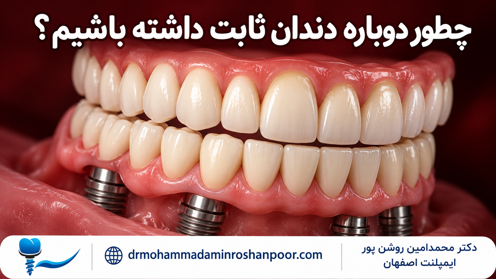 تصویرسازی آموزشی ایمپلنت کامل فک با نام دکتر محمدامین روشن پور و آدرس سایت