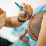 همه چیز درباره‌ی کاشت مو