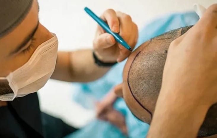 همه چیز درباره‌ی کاشت مو